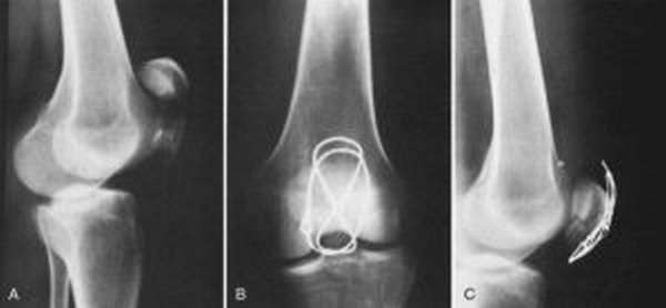 Рентгеновский снимок перелома надколенника
